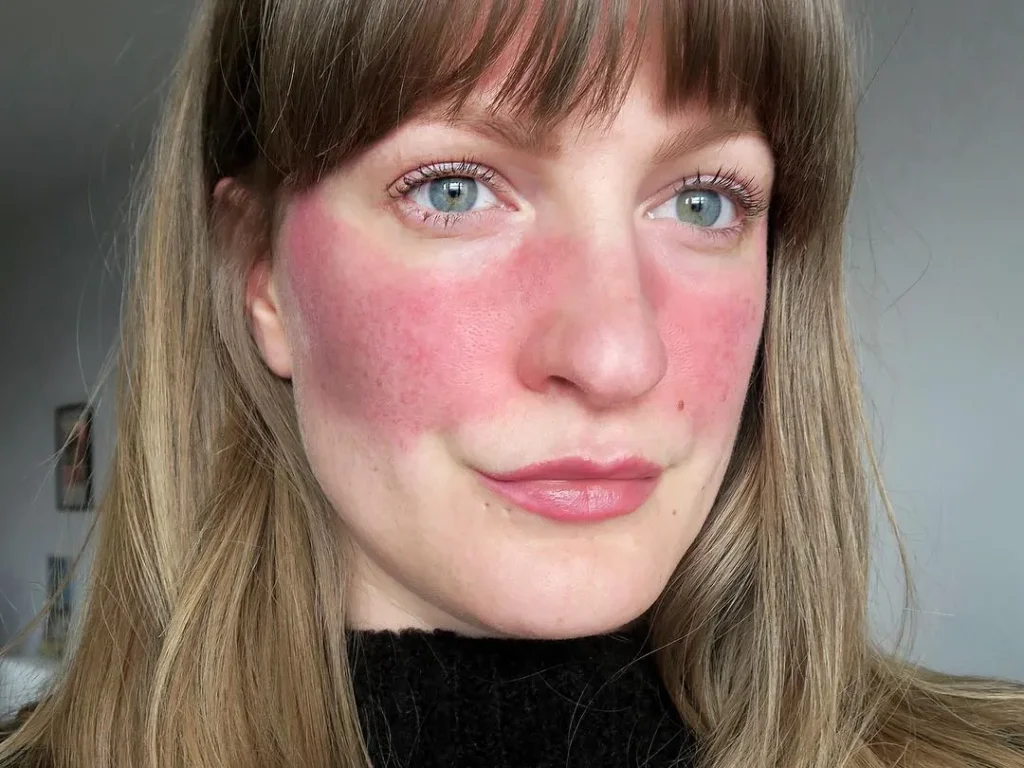 Rosacea - Rødhet i ansiktet
