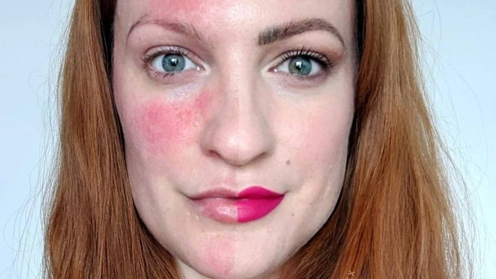 rosacea ansikt
